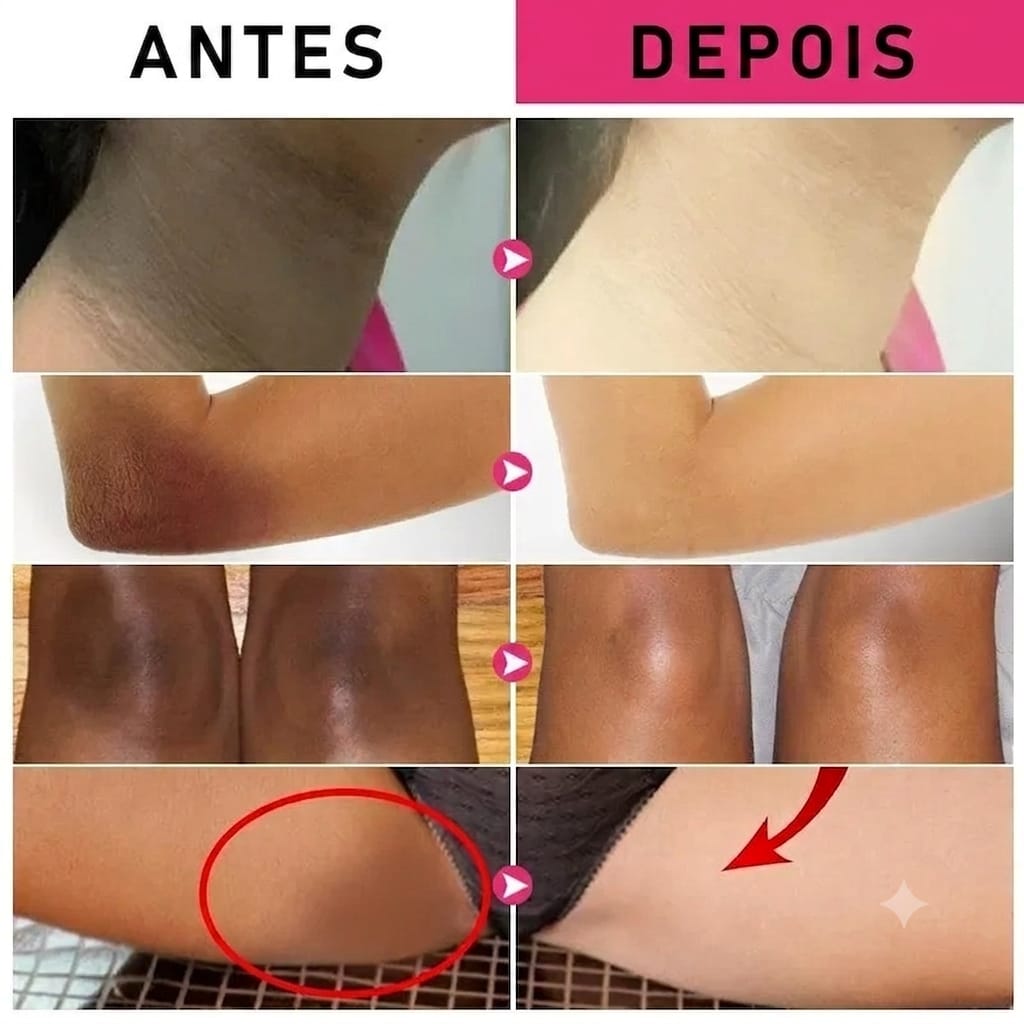 Comparativo antes e depois em pescoço, braços, joelhos e virilha